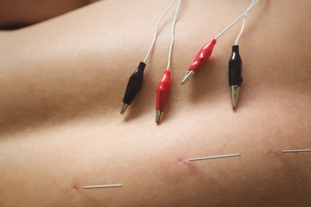 Dry Needling Therapy